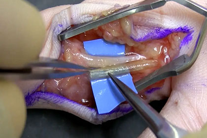 Wrapping cable grafted Avance® Nerve Graft using AxoGuard® Nerve Protector