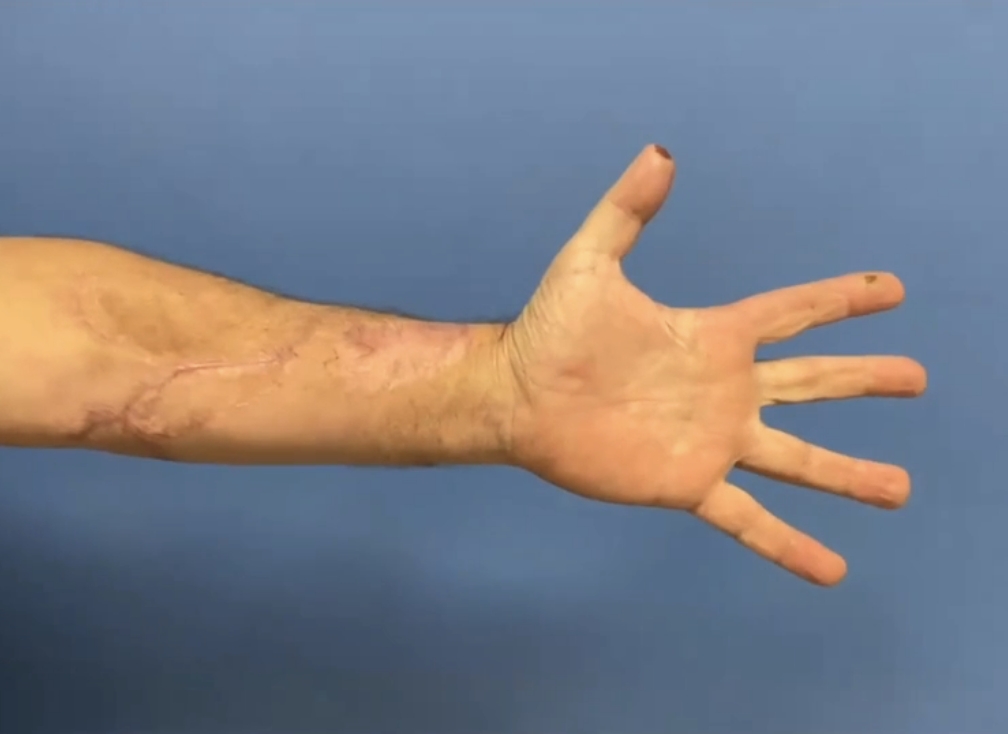 A photo of a forearm with hand open and fingers splayed out