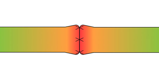 An illustration showing localized tension at the coaptation site of a direct nerve repair