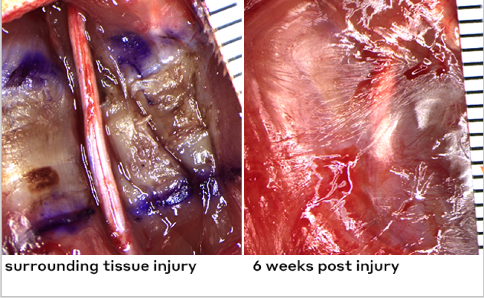 Surgical photo of a nerve with caption “surrounding tissue injury” alongside photo of improperly healed nerve with caption “6 weeks post injury”