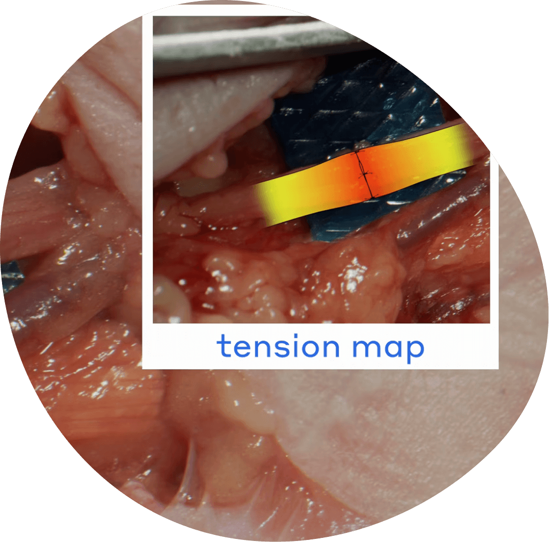 Video thumbnail: Understanding Axial tension: Direct Repair vs. Connector Assisted Repair