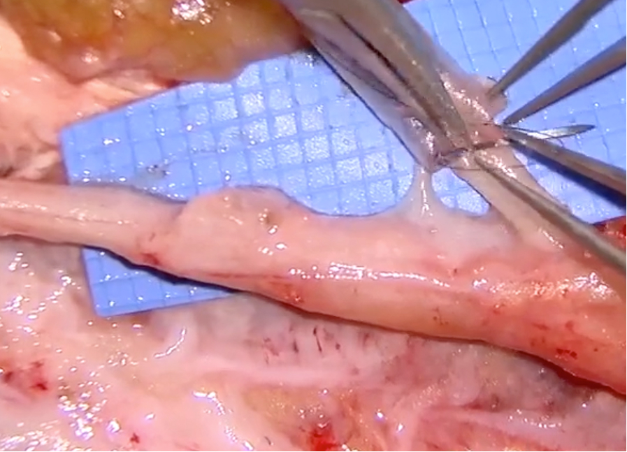 Video thumbnail: Neuroma Resection with Axoguard Nerve Cap