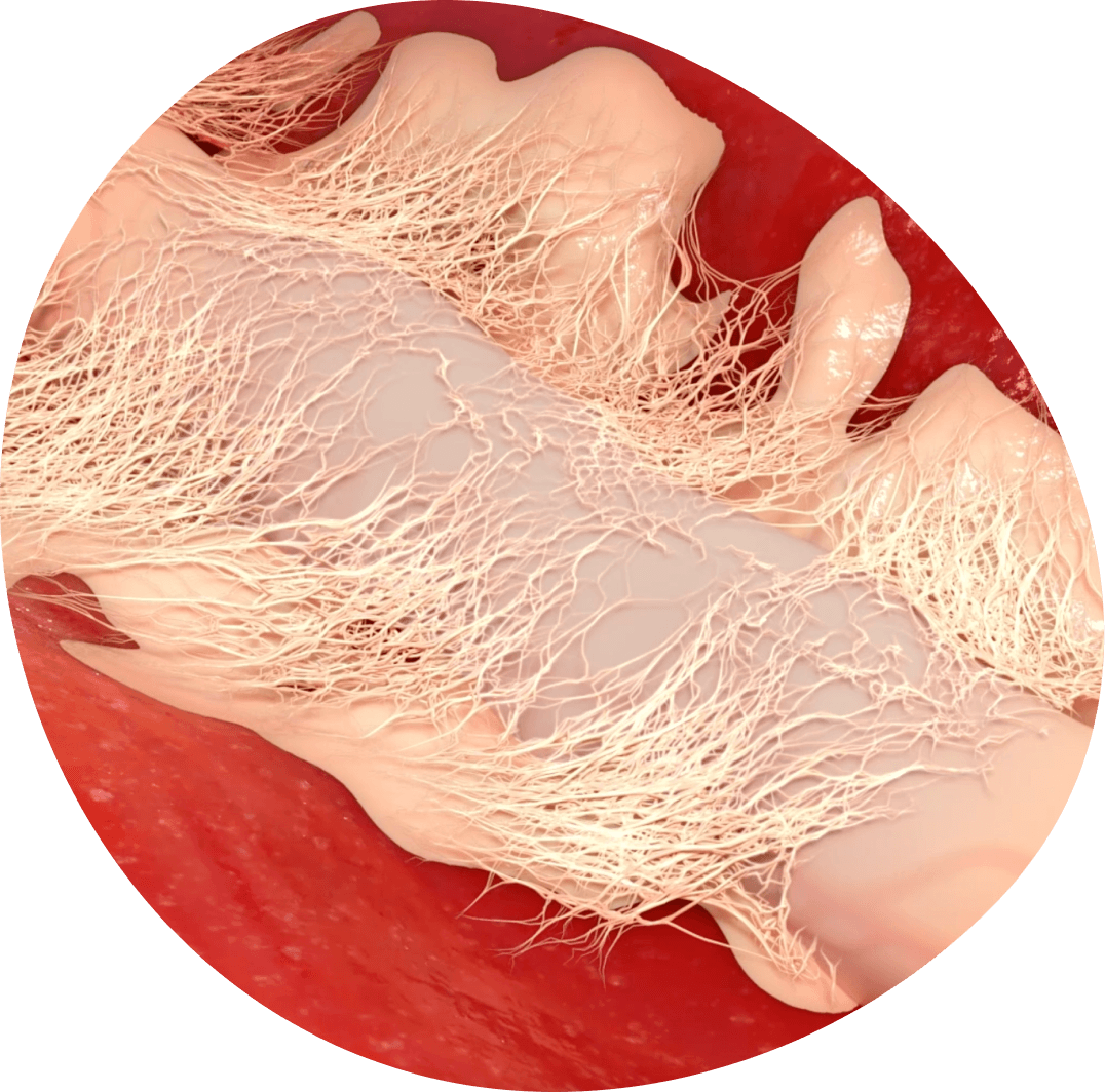 Video thumbnail: See how Axoguard HA+ Nerve Protector works