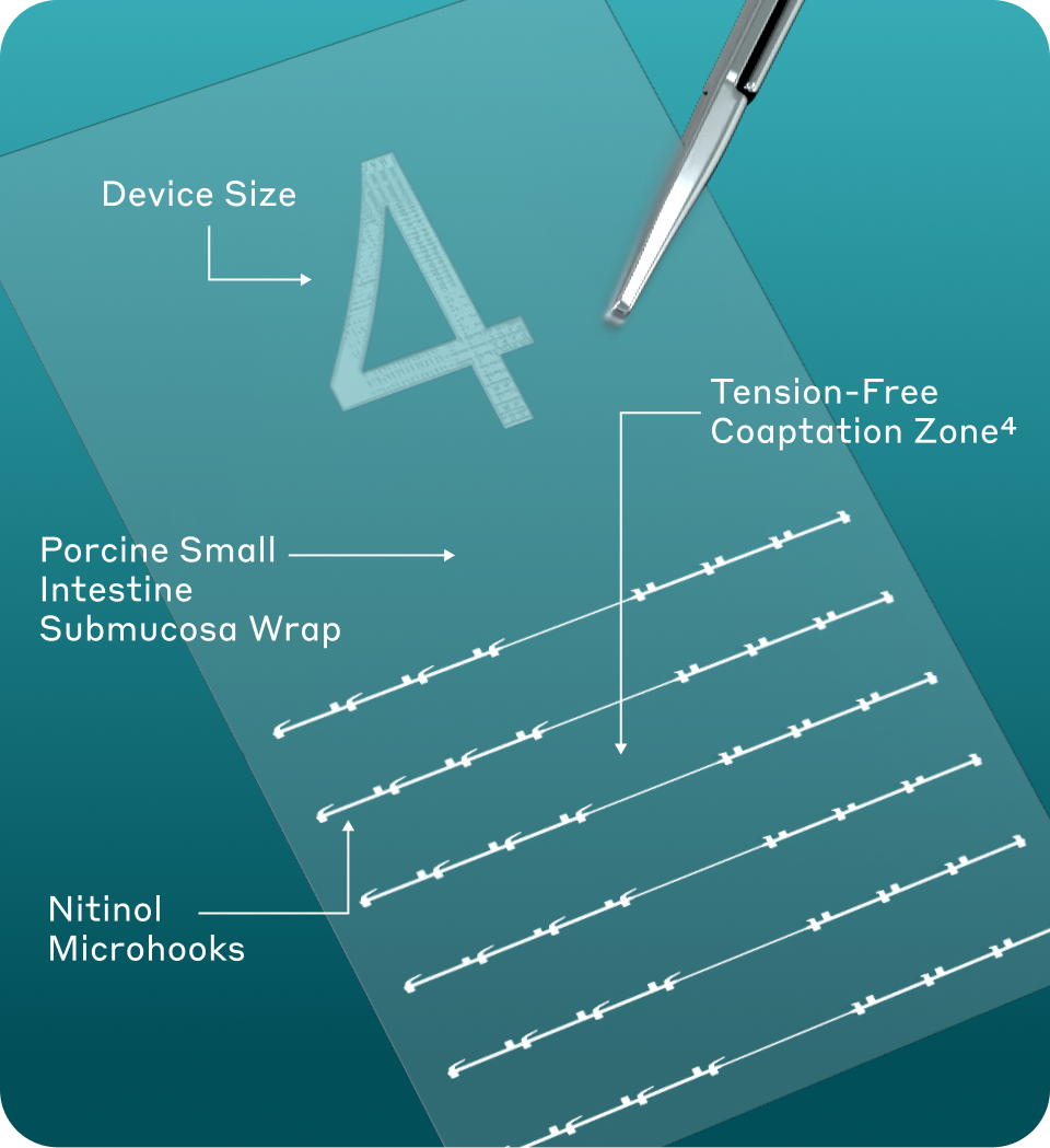 Labeled diagram of Nerve Tape size 4 showing the submucosa wrap, nitinol microhooks, and central coaptation zone.